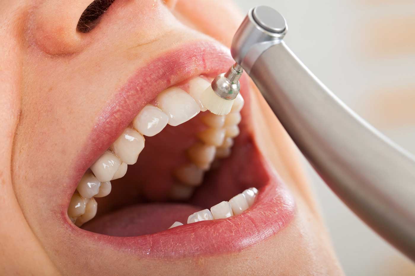 Individuelle Prophylaxe beim Zahnarzt in Bergneustadt